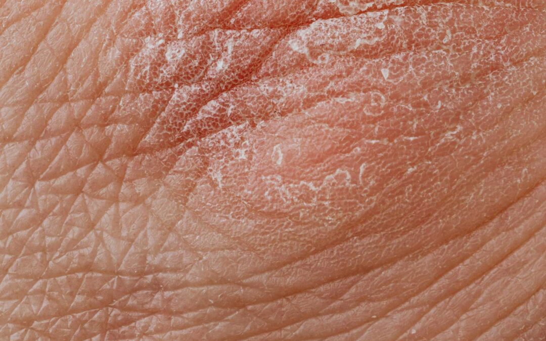 “What’s the Connection between Gut Health and Psoriasis?”